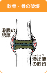 軟骨・骨の破壊