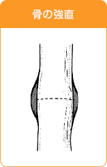 骨の強直