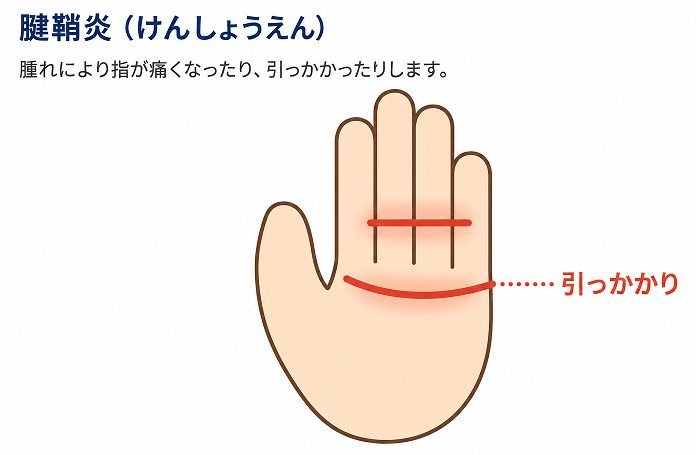 関節リウマチに伴う腱鞘炎とばね指の模式図
